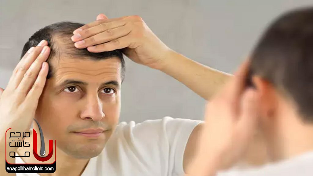 دلیل ریزش مو در مردان