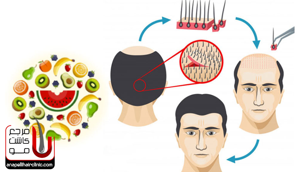 چرا تغذیه مناسب بعد از کاشت مو توصیه می شود؟