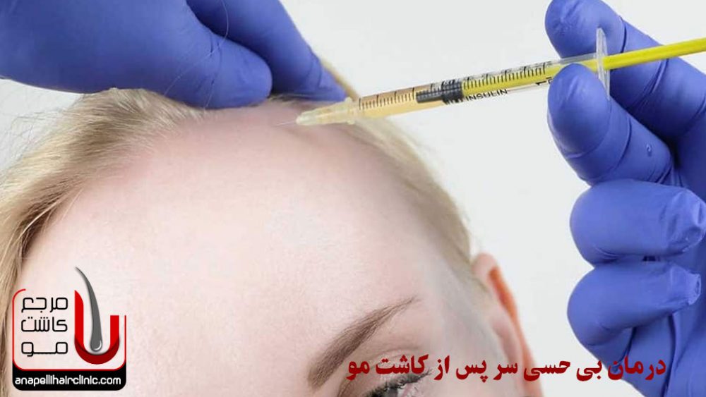 درمان بی حسی سر پس از کاشت مو