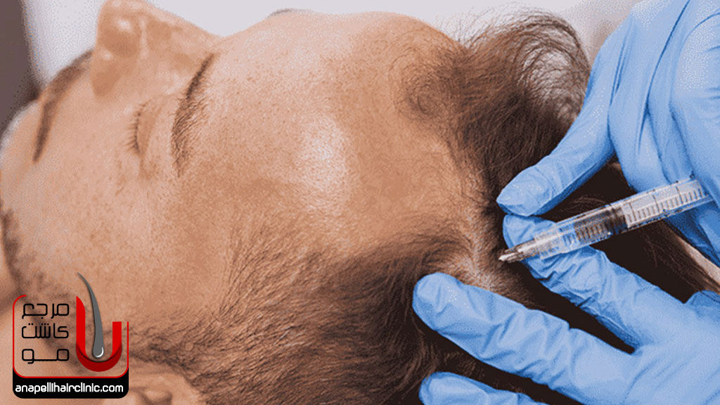 درمان بی حسی سر پس از کاشت مو
