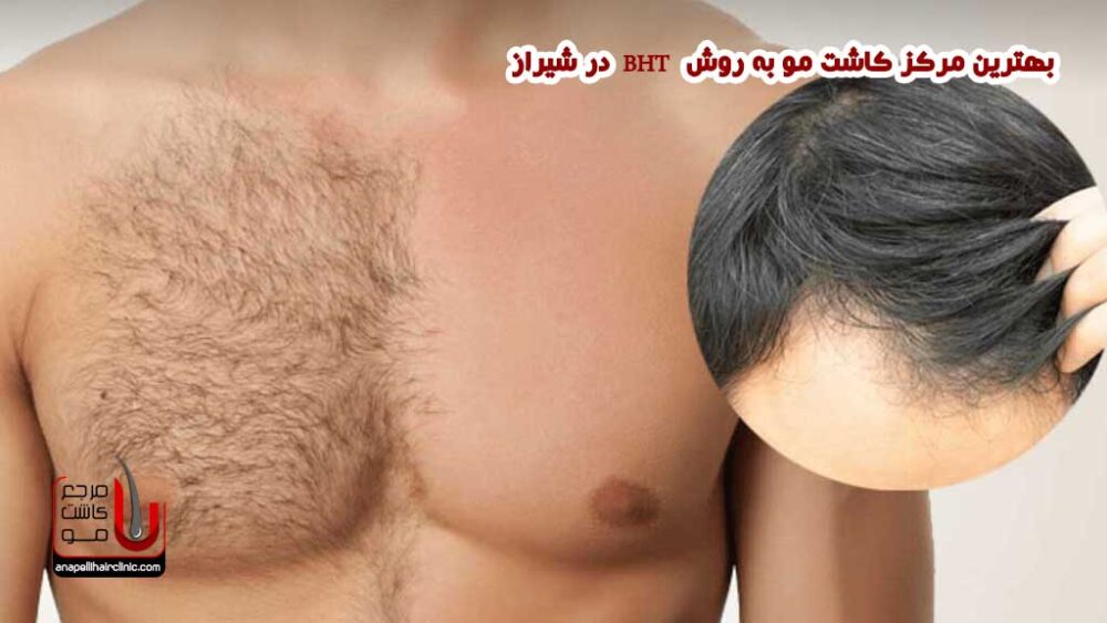 کاشت مو به روش BHT در شیراز