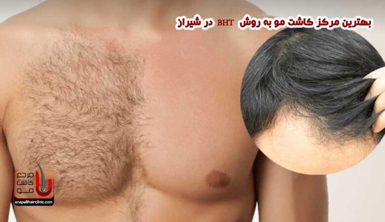 کاشت مو به روش BHT در شیراز
